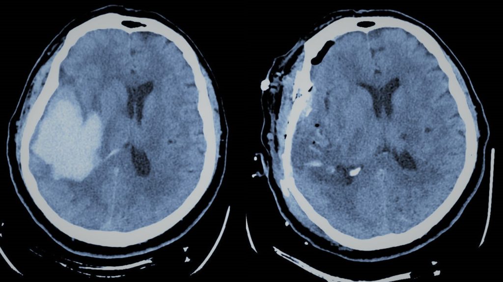 Hemorragia cerebral