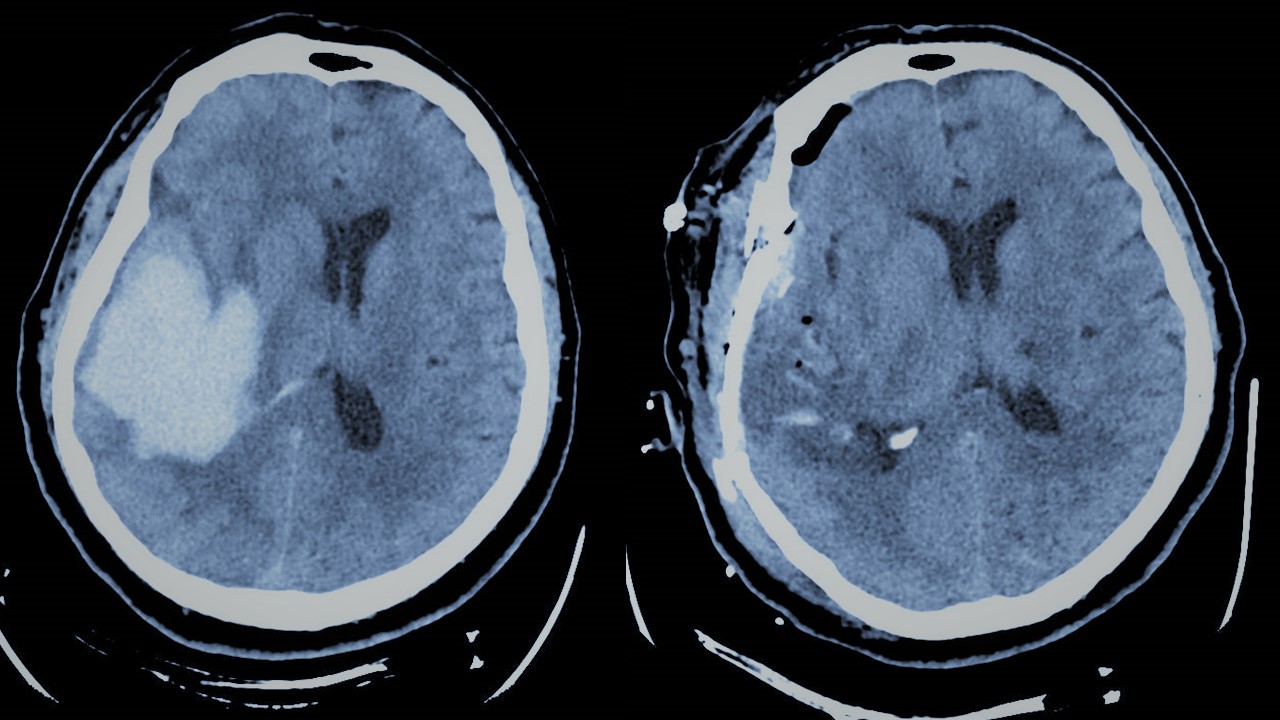 Hemorragia cerebral, el reto de conocer sus secuelas y daños